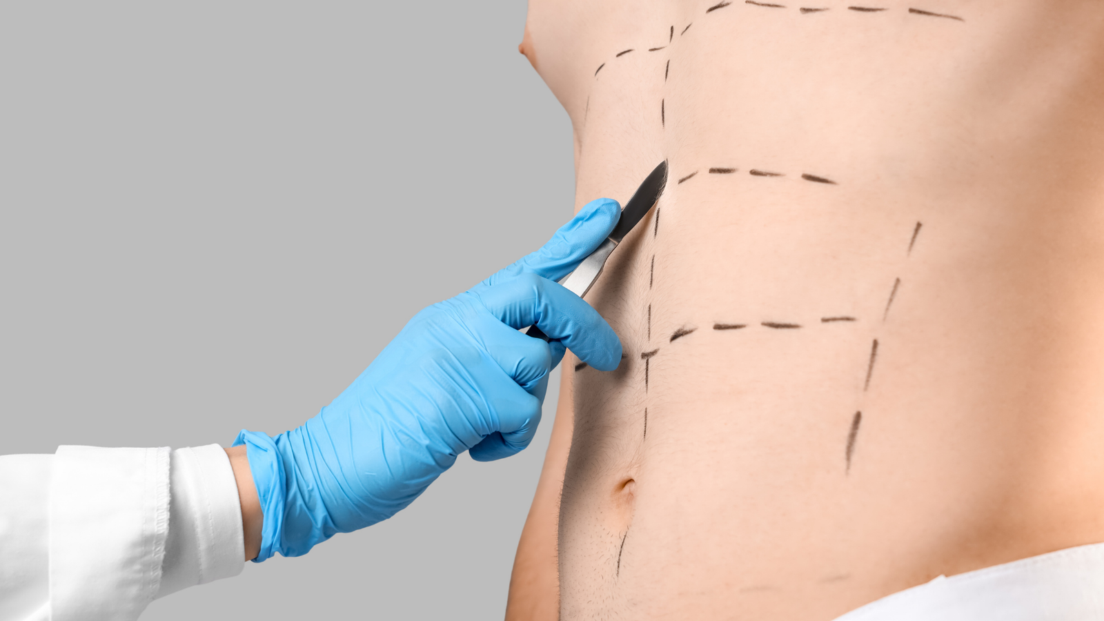 Abdominoplastia | Dr. Victor Rezende | Cirurgião Plástico